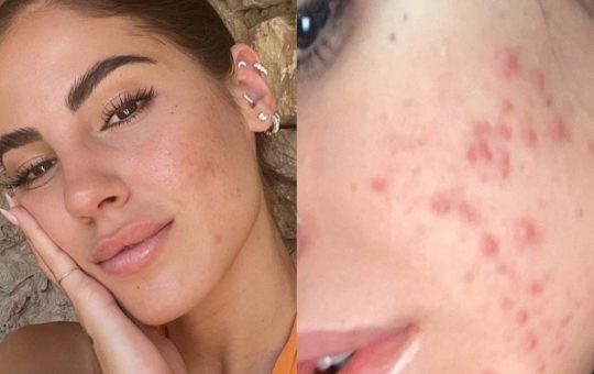 Giulia De Lellis- acne_ solocine.it